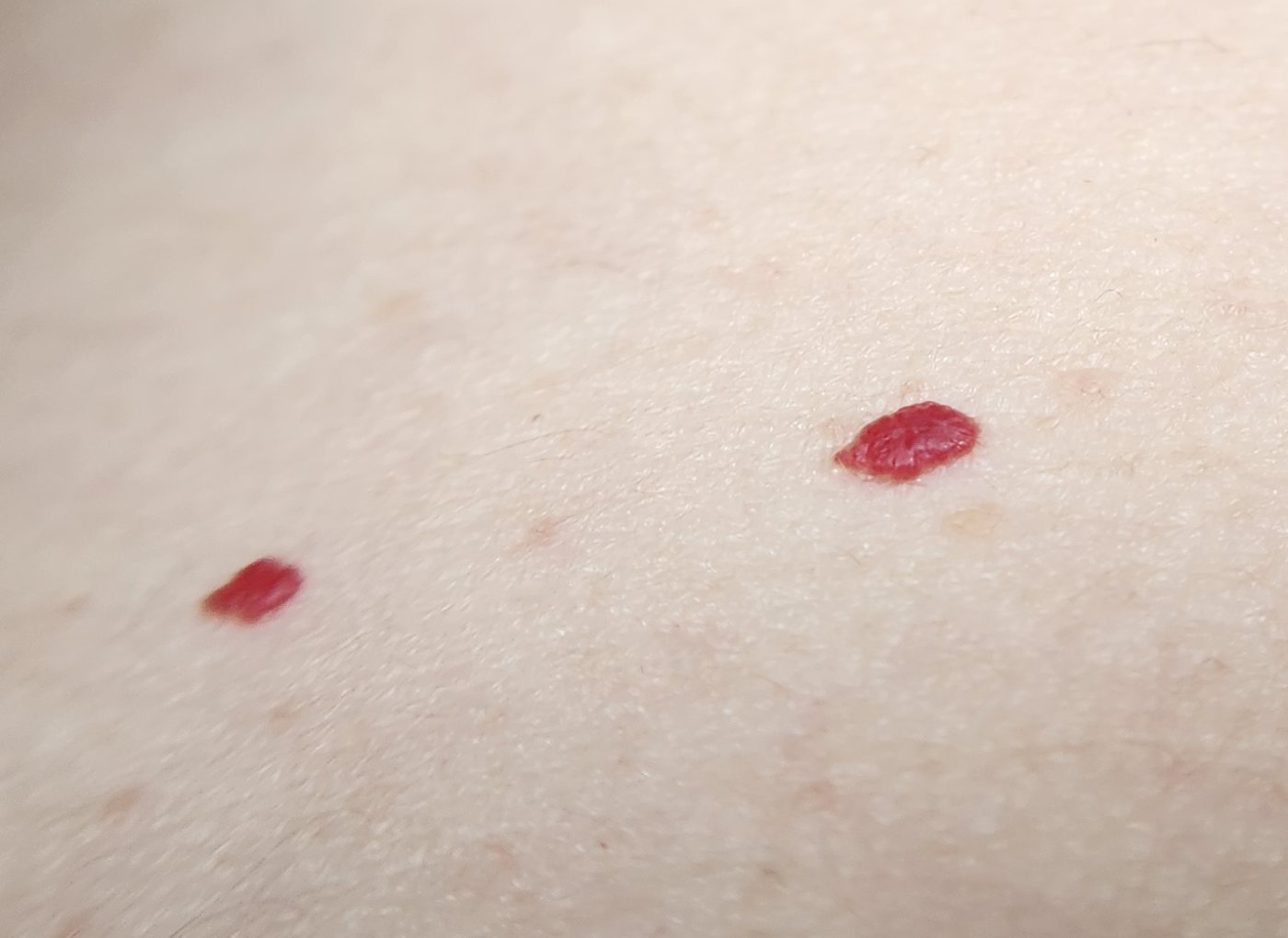 Close-up of two cherry angiomas, small bright red spots on the skin