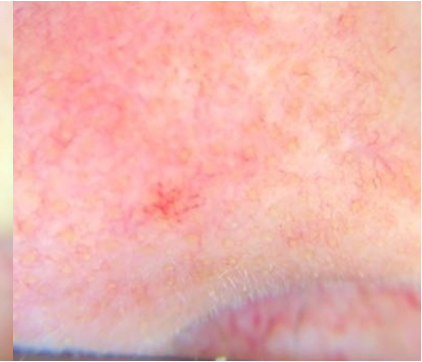 The same area after thermocoagulation treatment, with the cherry angioma resolved