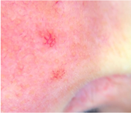 A cherry angioma on the cheek, before thermocoagulation treatment