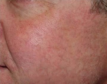 The same cheek after thermocoagulation treatment, with the thread veins cleared