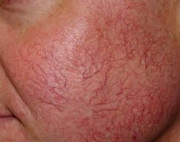 Visible facial thread veins on the cheek, before thermocoagulation treatment