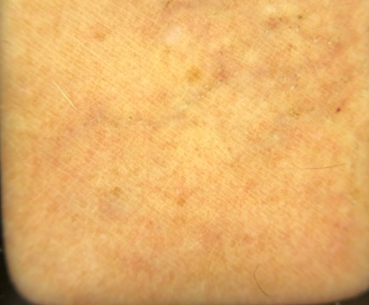 The same area of leg after thermocoagulation treatment, with the thread veins cleared
