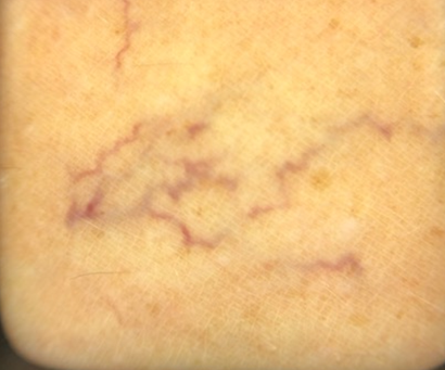 Close-up of leg thread veins, before thermocoagulation treatment