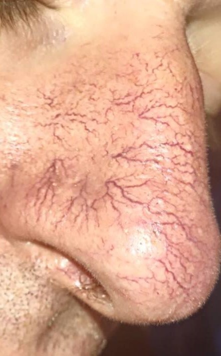 Close-up of thread veins around the side of the nose