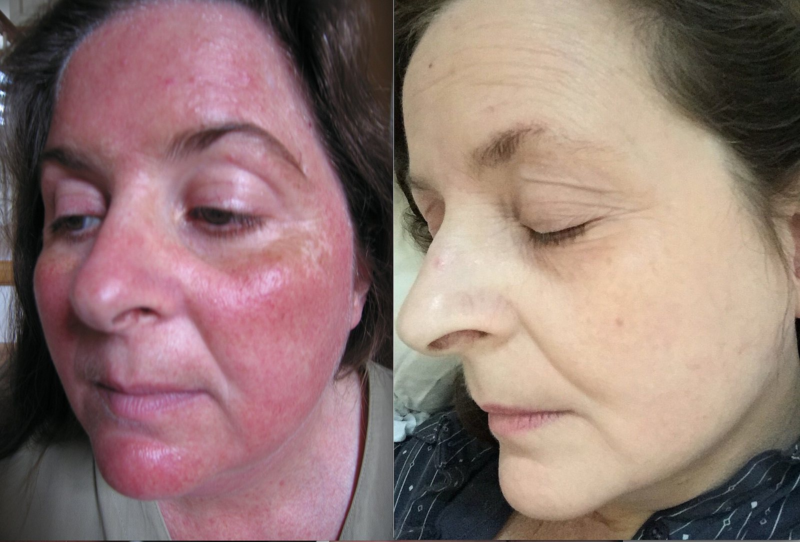 A woman's face with rosacea redness across the cheeks and nose, and the same face after treatment with the redness settled