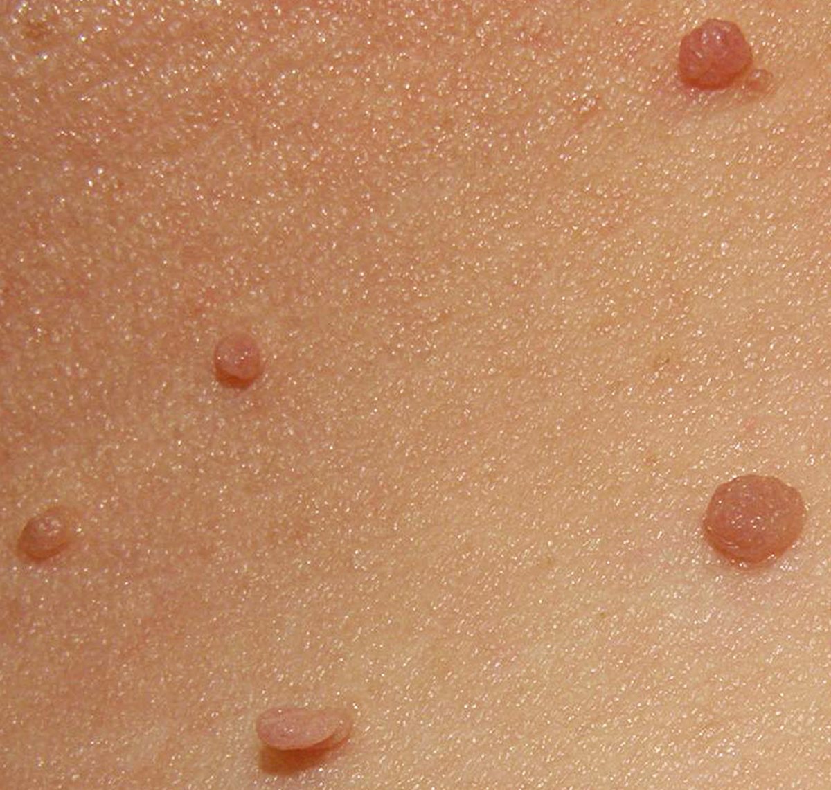 Several small, skin-coloured skin tags on the neck