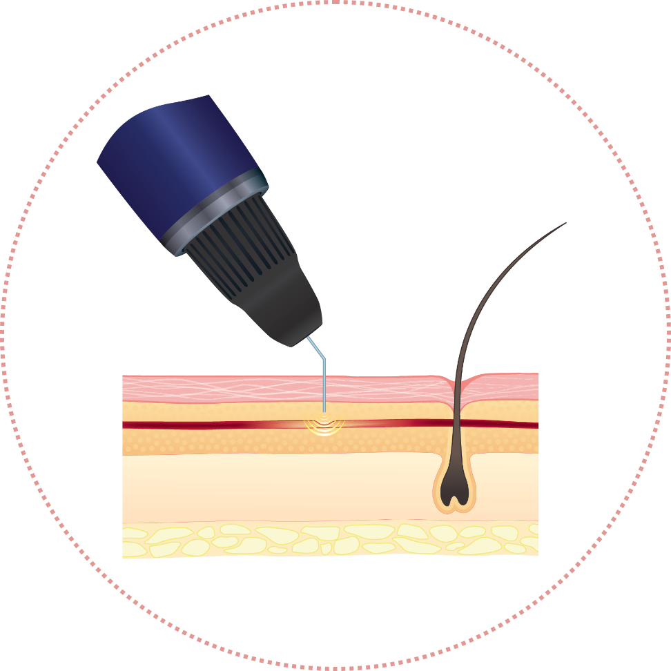 Diagram of the ThermaVein probe sealing a thread vein just beneath the skin