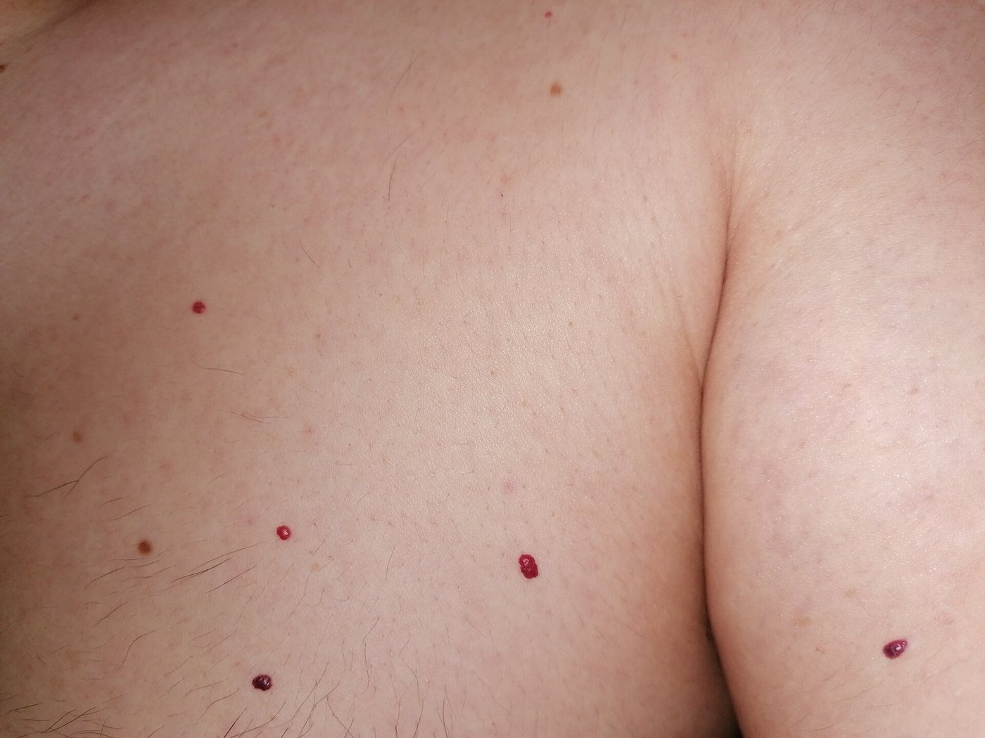 Several small benign vascular lesions scattered across the chest and upper arm