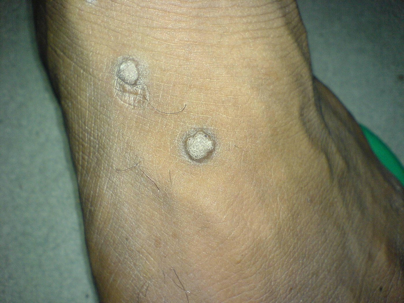 Two common warts (verruca vulgaris) on the skin