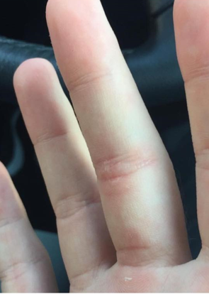 The same finger after thermocoagulation treatment, with the wart resolved