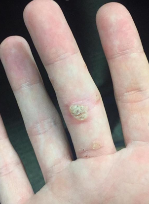 A wart on a finger, before thermocoagulation treatment